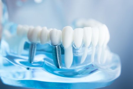 Kuo ypatingas „All-on-4“ dantų atkūrimo būdas?