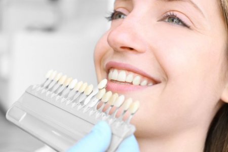 Dantų restauravimas laminatėmis: procedūra verta investicijų?
