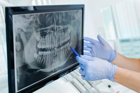 Dantų implantacijos eiga: ko tikėtis?