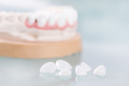Estetinis dantų plombavimas ar dantų laminatės?